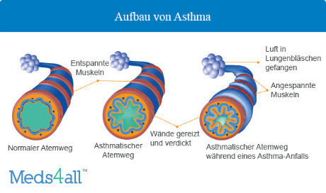 Asthma bronchiale Aufbau