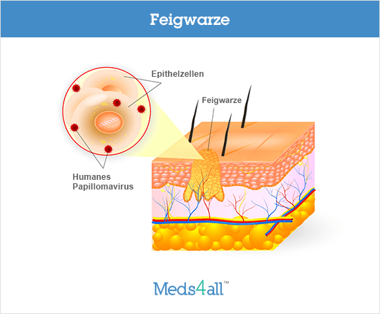 Feigwarzen Behandlung Online • Rezept inkl. • Meds4all®