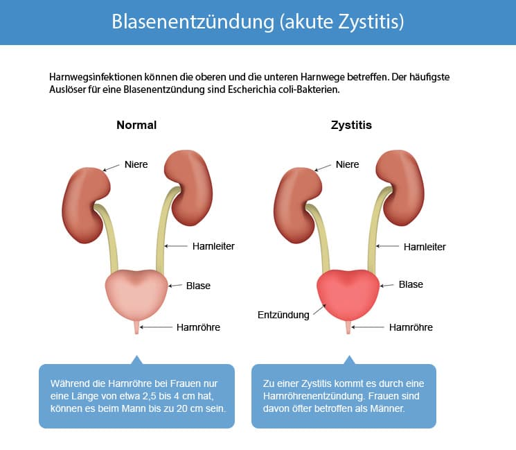 Chronische Blasenentzundung Was Hilft Melina Dulce