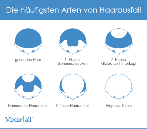 Arten von Haarausfall