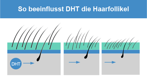 Wirkung von DHT auf Haarwurzel