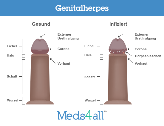 Anzeichen frau genitalherpes