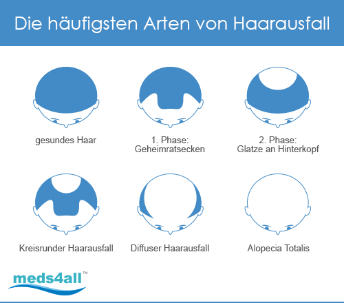 Arten von Haarausfall