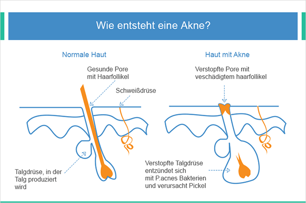 Haut mit Akne